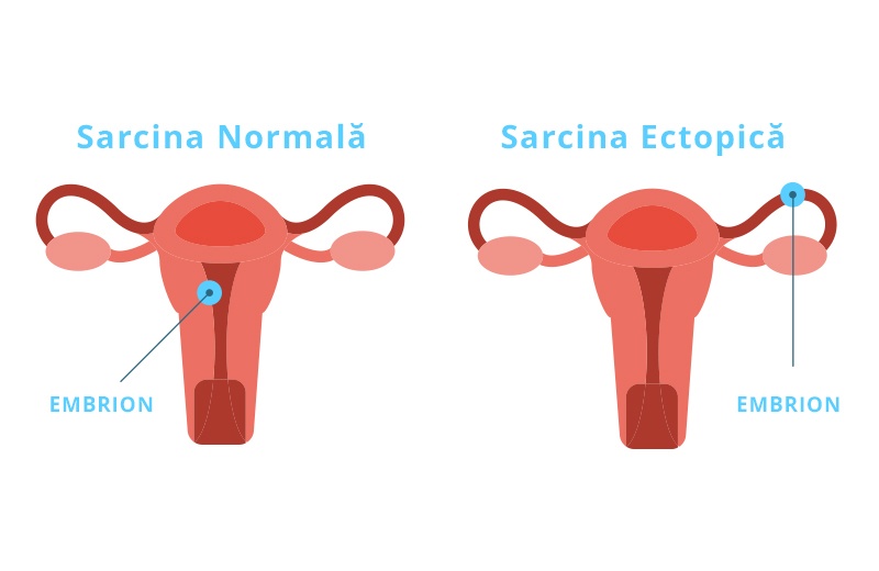 Sarcina Extrauterină: Care sunt cauzele, ce complicații pot surveni