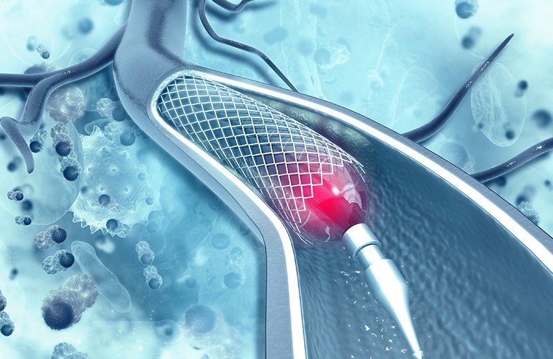 Stent Rima Operația de stent la inimă | PortalMed